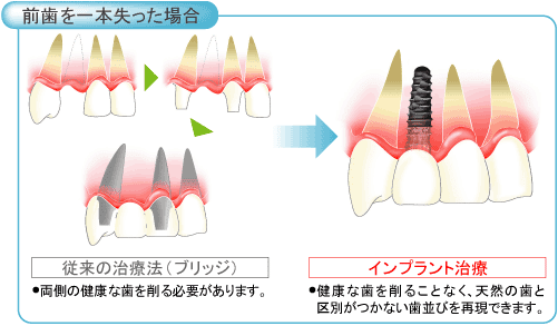 インプラント治療