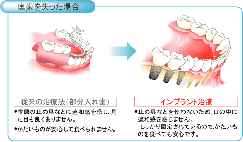 インプラント治療