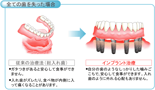 インプラント治療