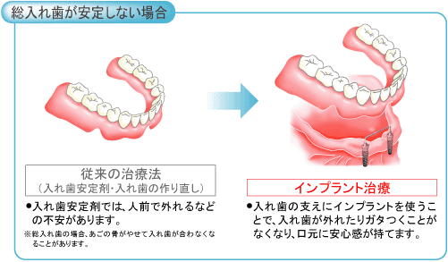 インプラント治療