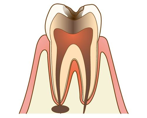根尖性歯周炎
